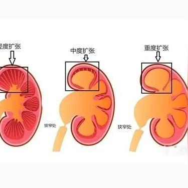 百度独家揭秘，肾功能异常的全面深度解析