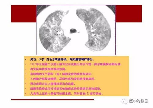 嗜巨细胞综合症深度解析，定义、症状、诊断、治疗与预防全攻略